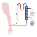 Renal hemodialysis scheme.